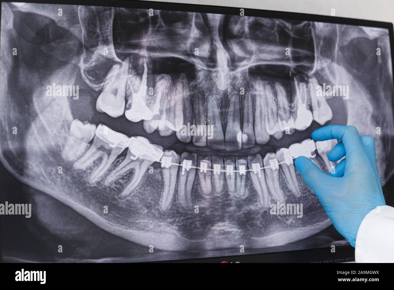 Doctor points to braces in dental xray Stock Photo Alamy