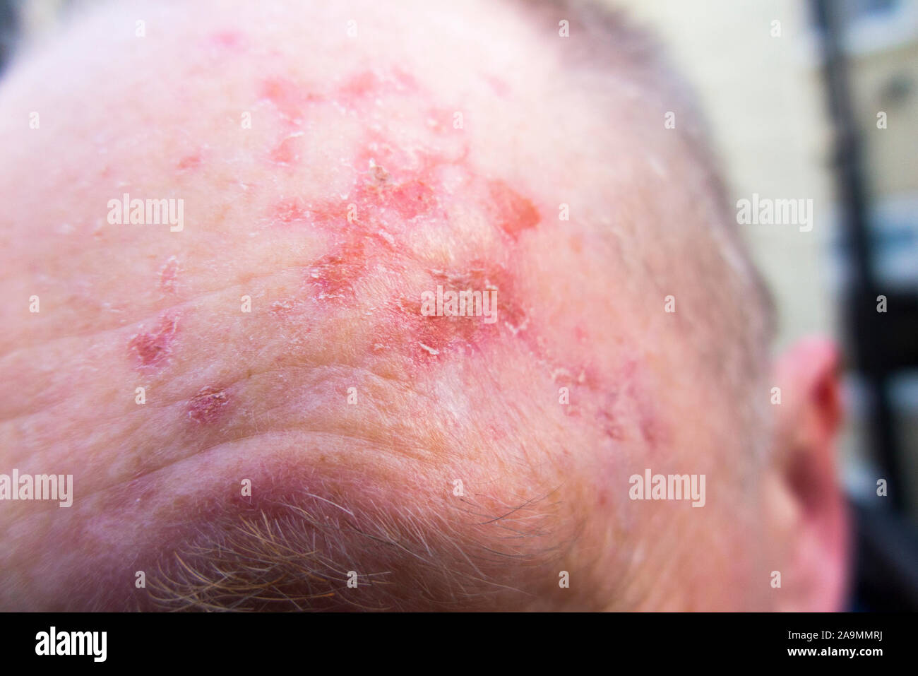 Forehead / head and scalp of a man whose Actinic Keratosis skin lesions