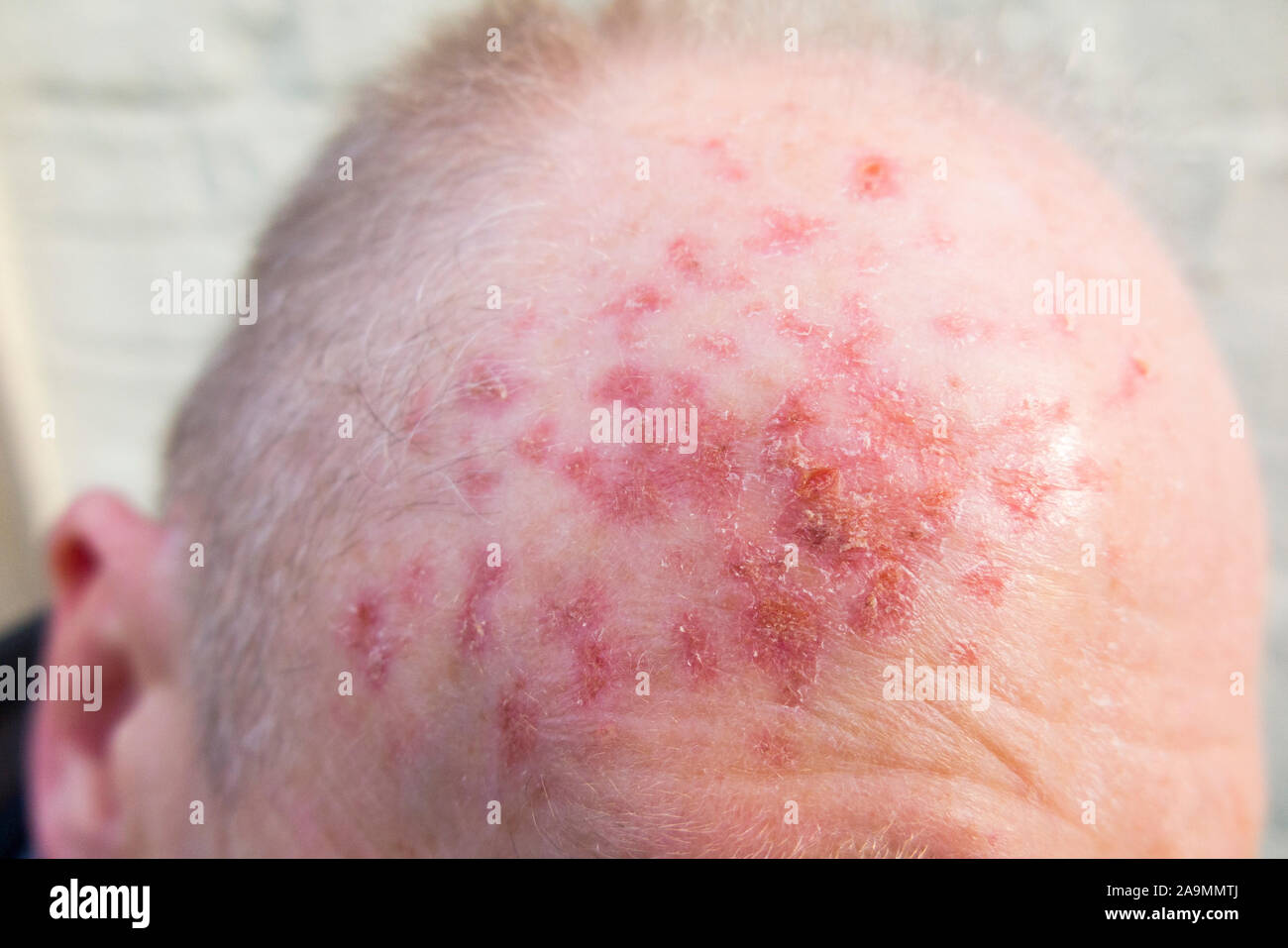 Forehead / head and scalp of a man whose Actinic Keratosis skin lesions ( long term sun damage to skin caused by UV radiation ) has been treated with Efudix cream to kill the abnormal and possibly pre cancerous cells. (114) Stock Photo