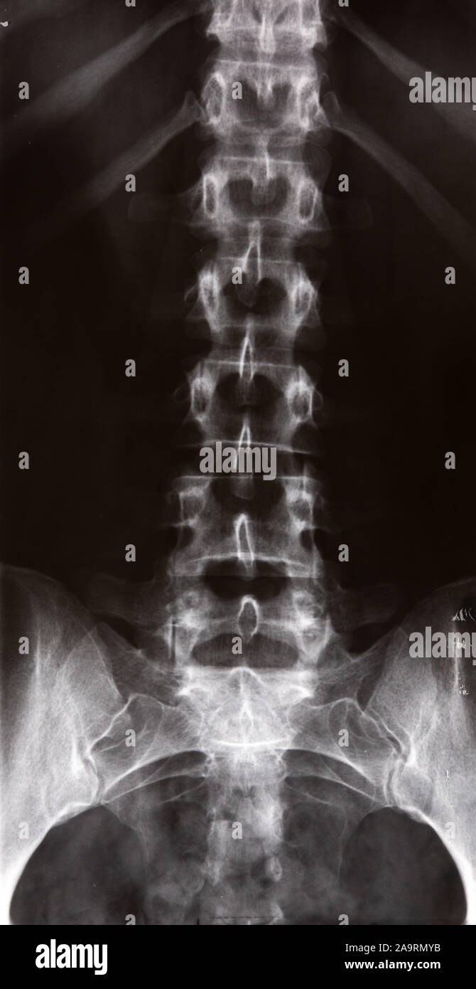 X-ray of a human showing the spine and pelvis Stock Photo - Alamy