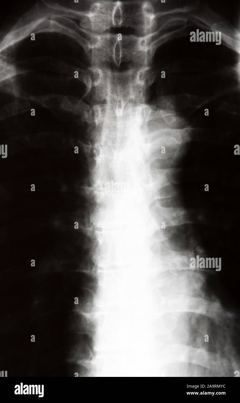 X-ray of a human showing the spine and pelvis Stock Photo - Alamy