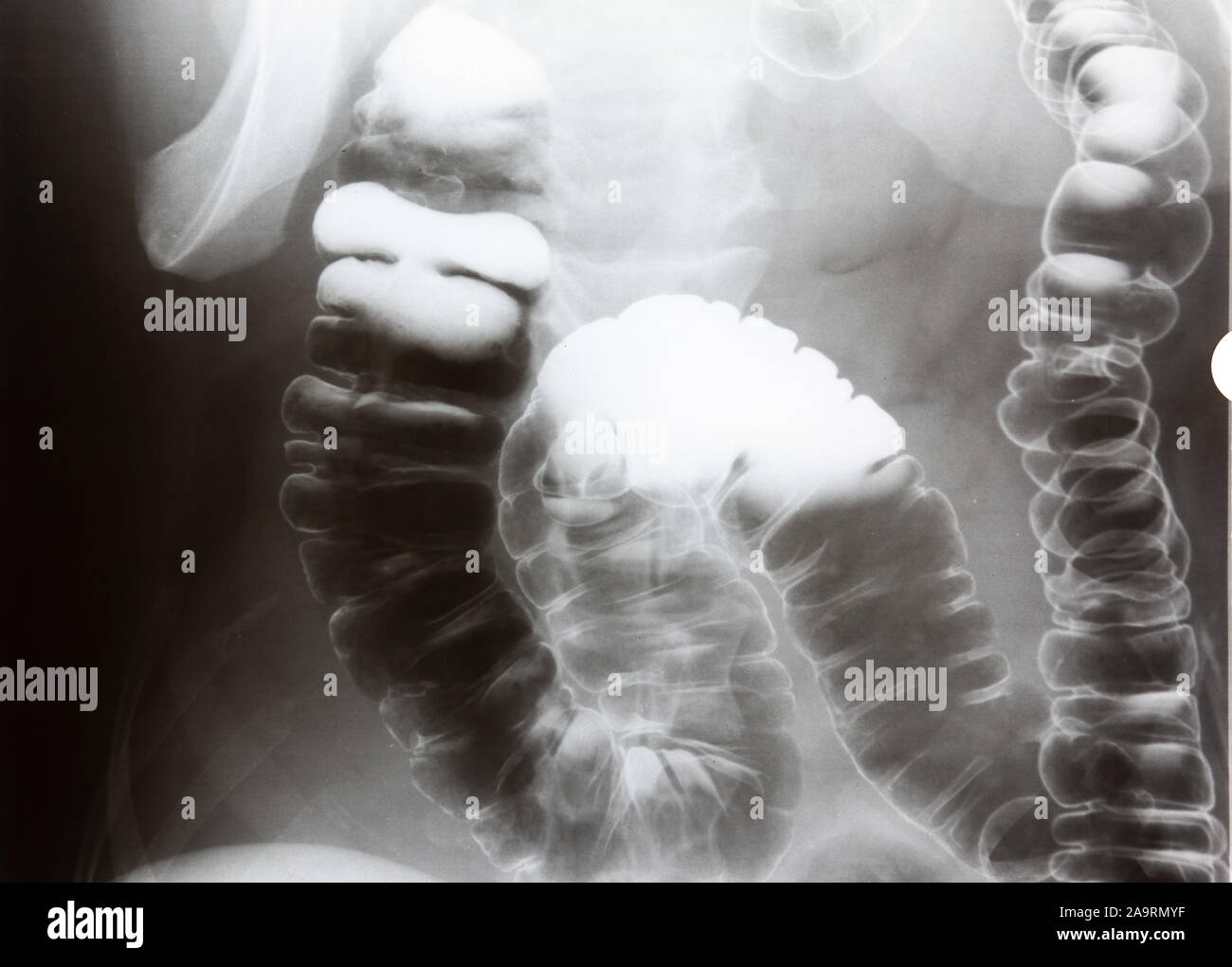 X-ray With Opaque Contrast Medium That Shows Intestine: Spine And Hip In  Background , With Marker Stock Photo, Picture and Royalty Free Image. Image  44132950.