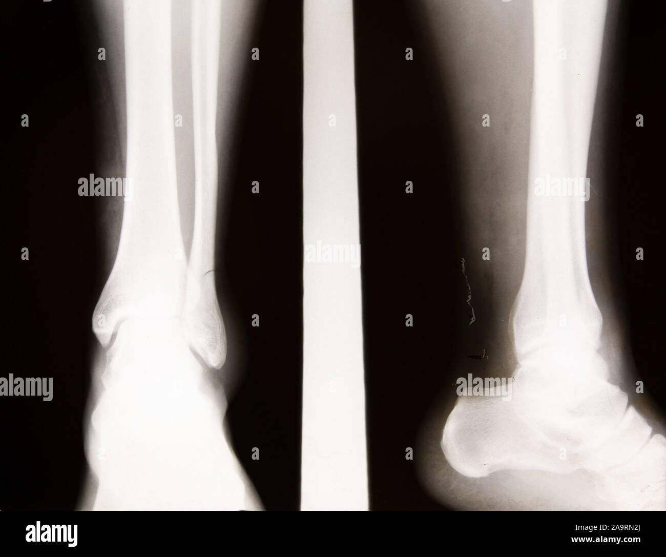 Shin Bone High Resolution Stock Photography and Images - Alamy