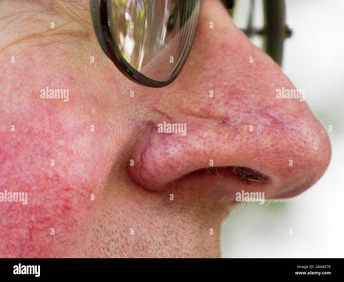 A close-up of an older white man's face with broken capillaries and veins in the skin on his nose and cheeks and enlarged pores Stock Photo