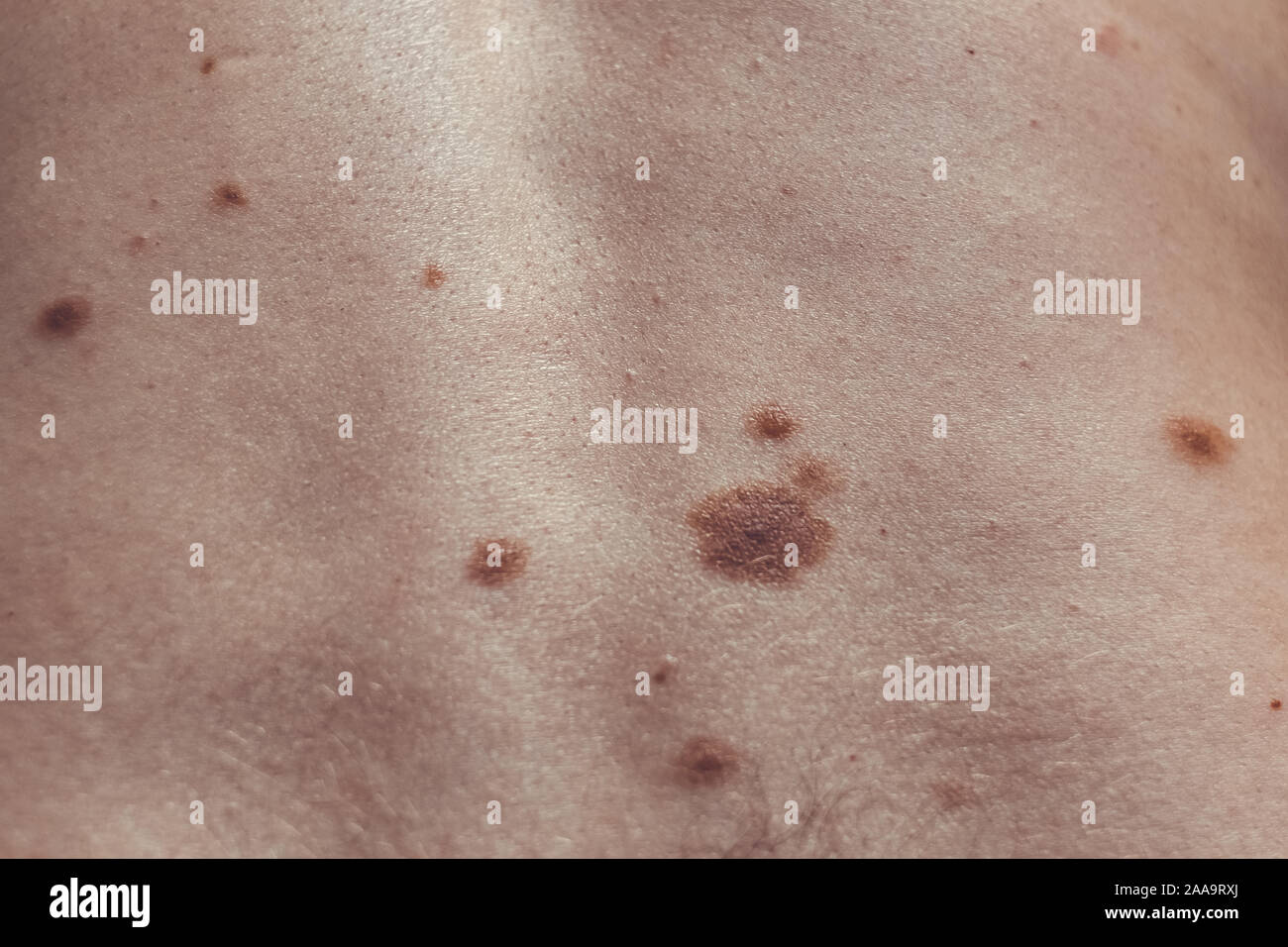 A melanocytic nevus also known as nevocytic or nevus-cell nevus and ...