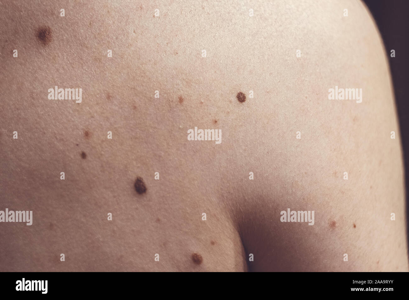 A melanocytic nevus also known as nevocytic or nevus-cell nevus and ...