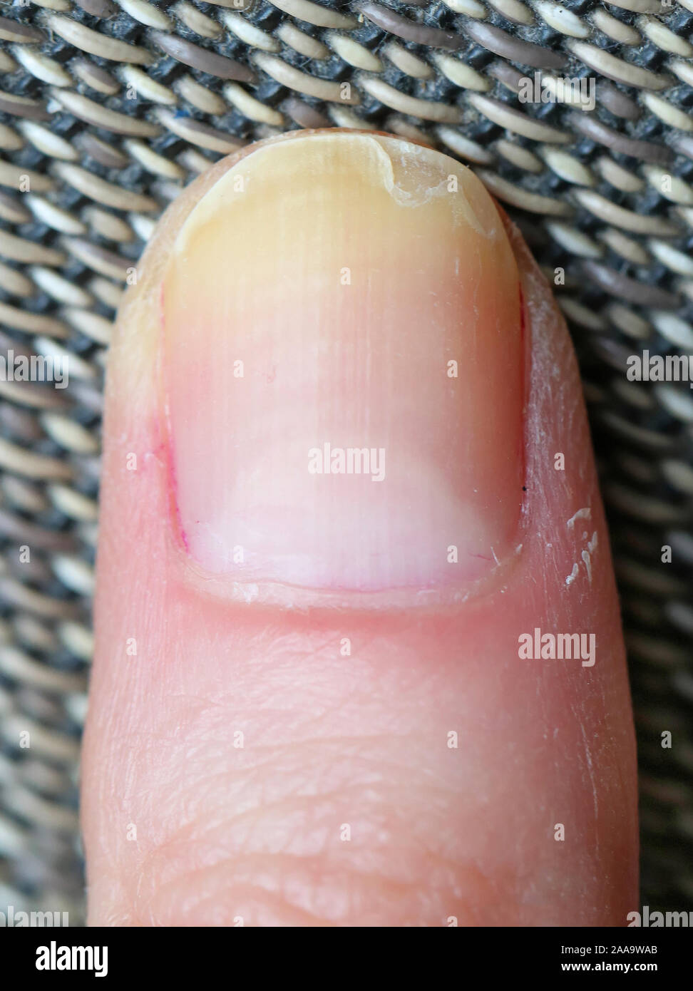 Share 125+ dry nail cuticles latest