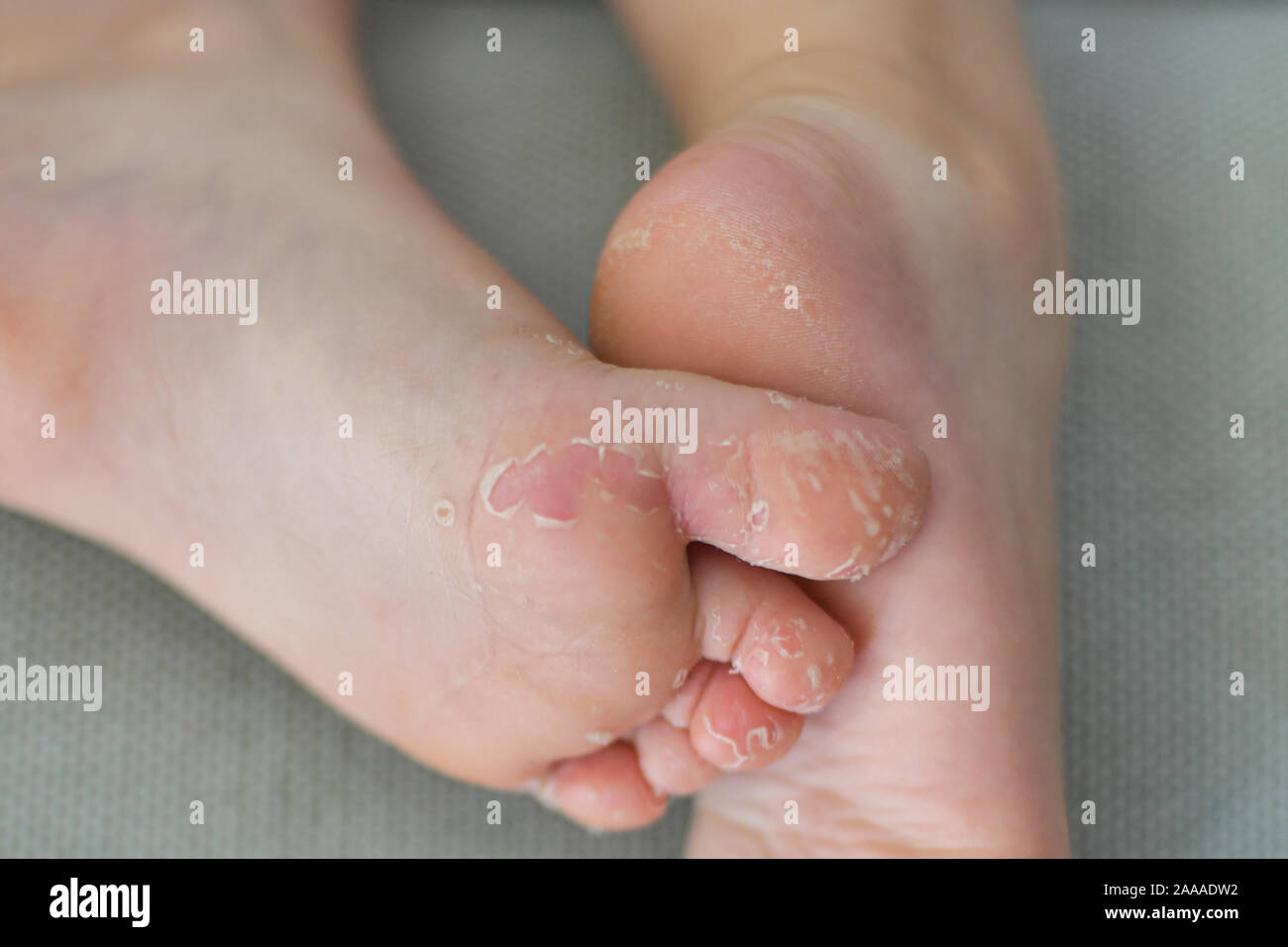 Enterovirus Foot Hand Mouth Skin Peeled Off On The Body Of A Child Cocksackie Virus Stock Photo Alamy
