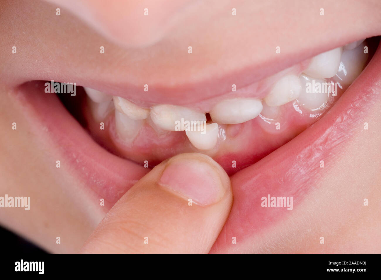 Gebiss einer Fünfjährigen mit wackeldem Zahn (mr) Stock Photo