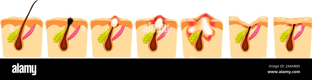 Types of acne. Closed comedones open comedones inflamed acne