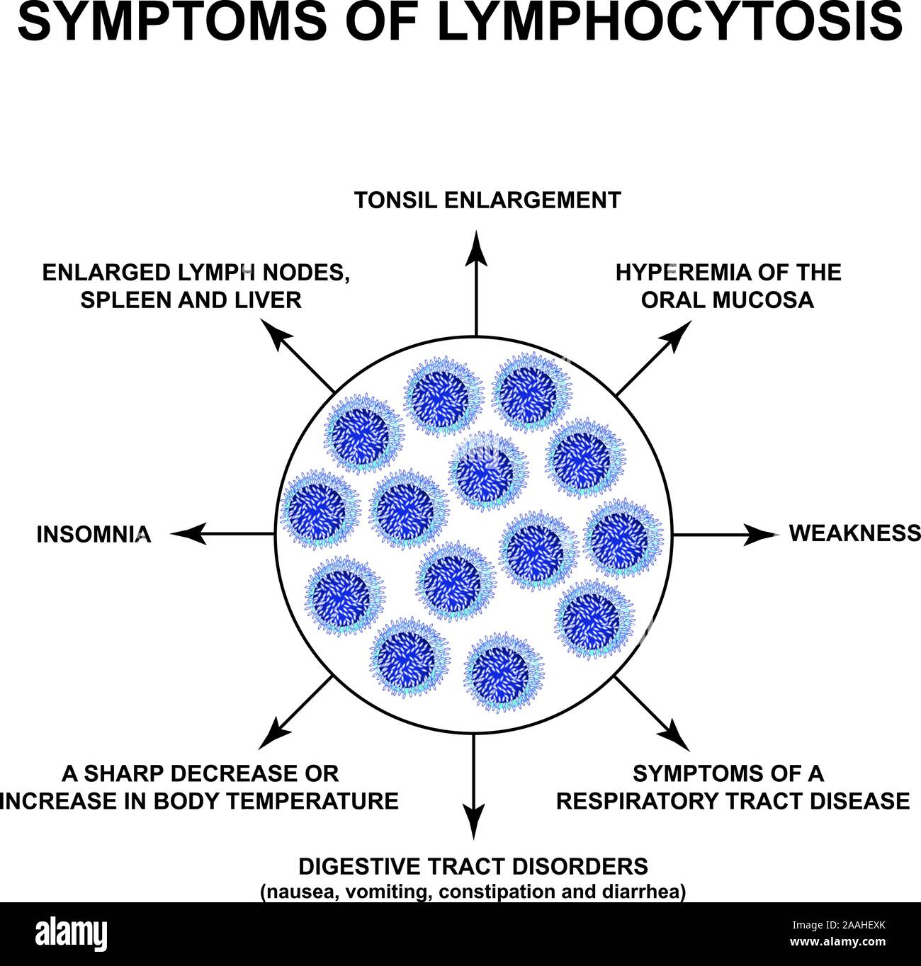 Symptoms Of Lymphocytosis. The Increase In Lymphocytes In The Blood ...