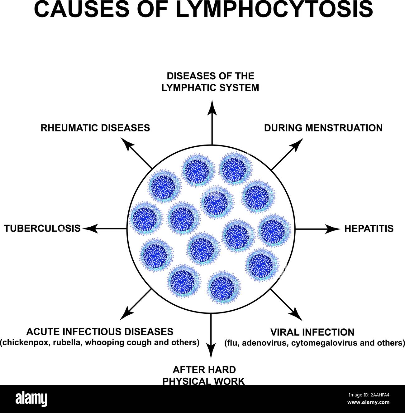 Causes of lymphocytosis. The increase in lymphocytes in the blood. Cell killers. Immunity Helper Cells. Infographics. Vector illustration on isolated Stock Vector
