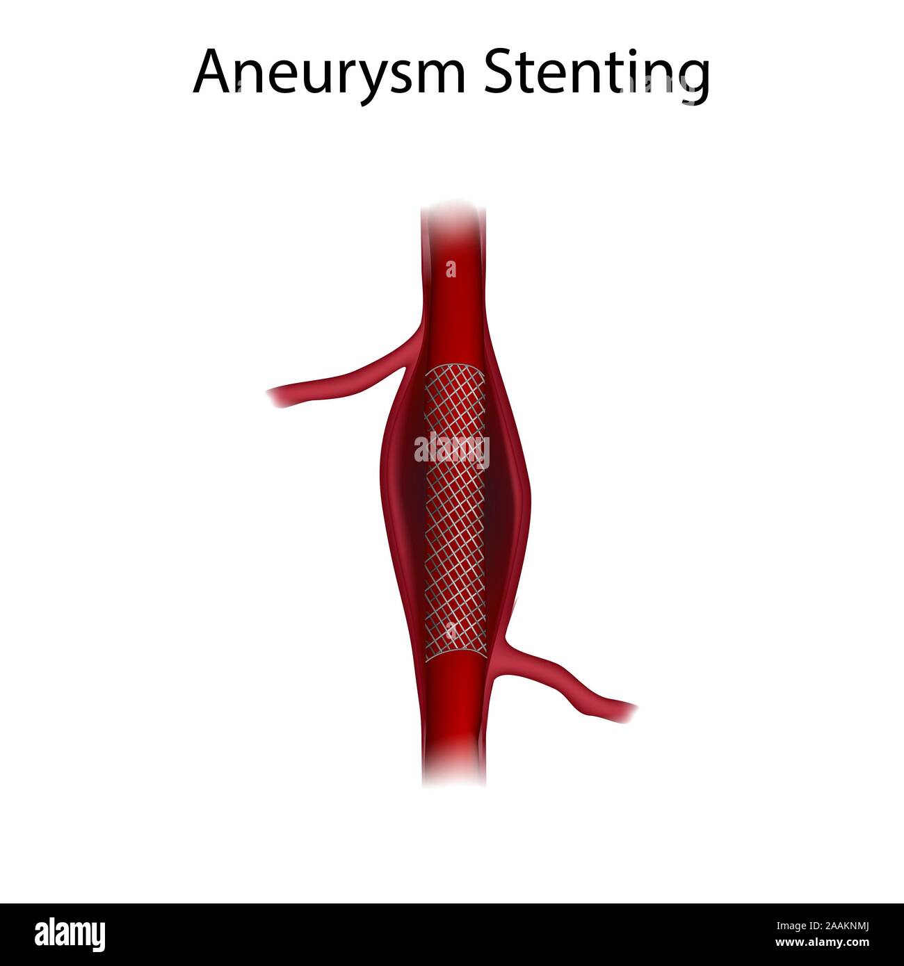 Aneurysm repair with stenting, illustration. Stock Photo