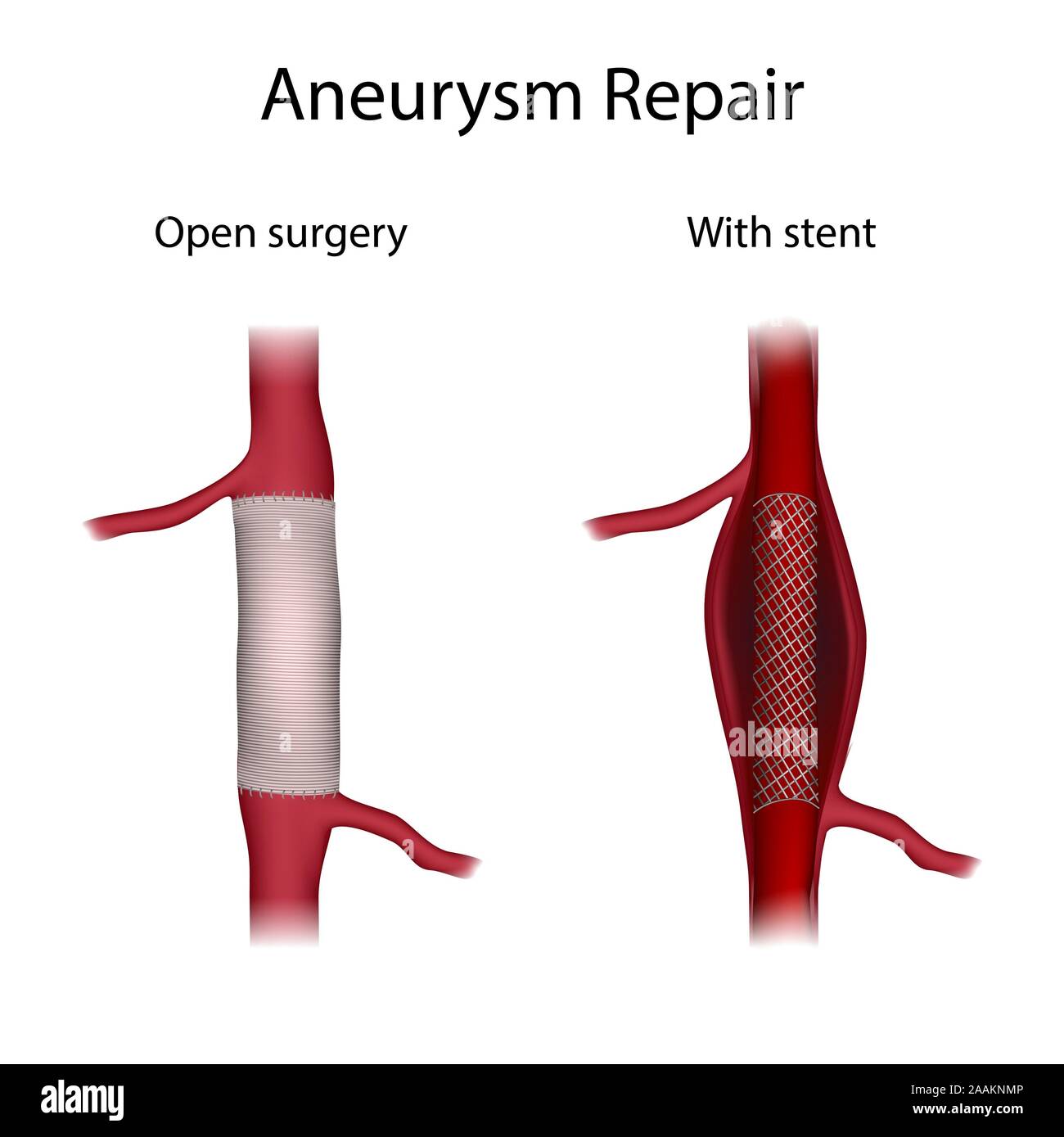 Aneurysm repair, illustration. Comparison of open surgery and stenting. Stock Photo