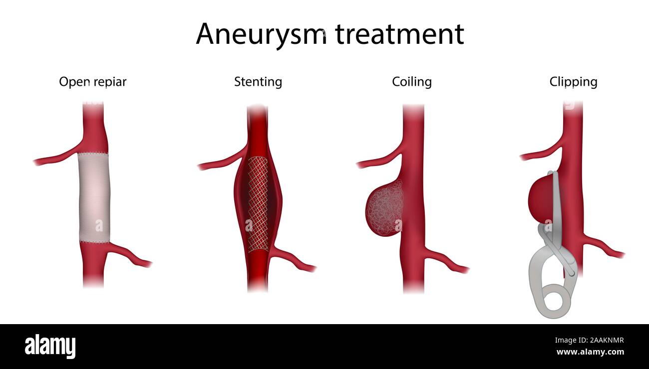 Aneurysm treatment, illustration. Comparison of clipping, open surgery  repair, stenting and coiling Stock Photo - Alamy
