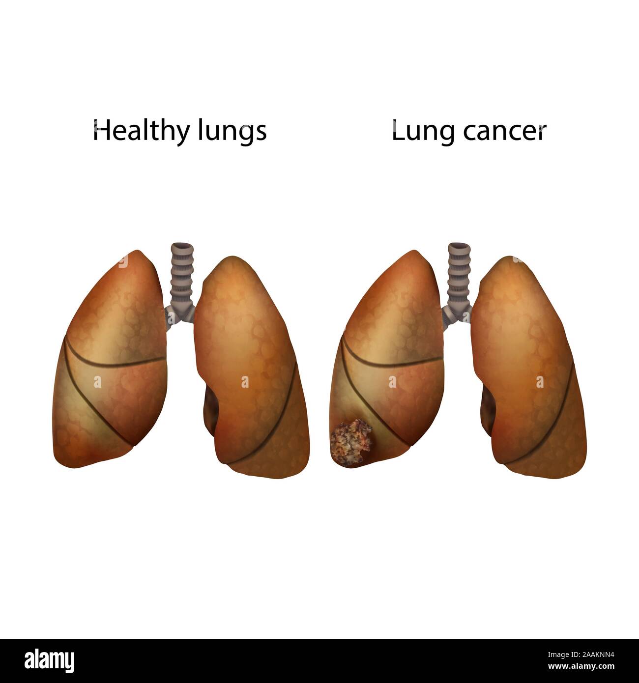 Lung cancer and healthy lungs, illustration Stock Photo - Alamy