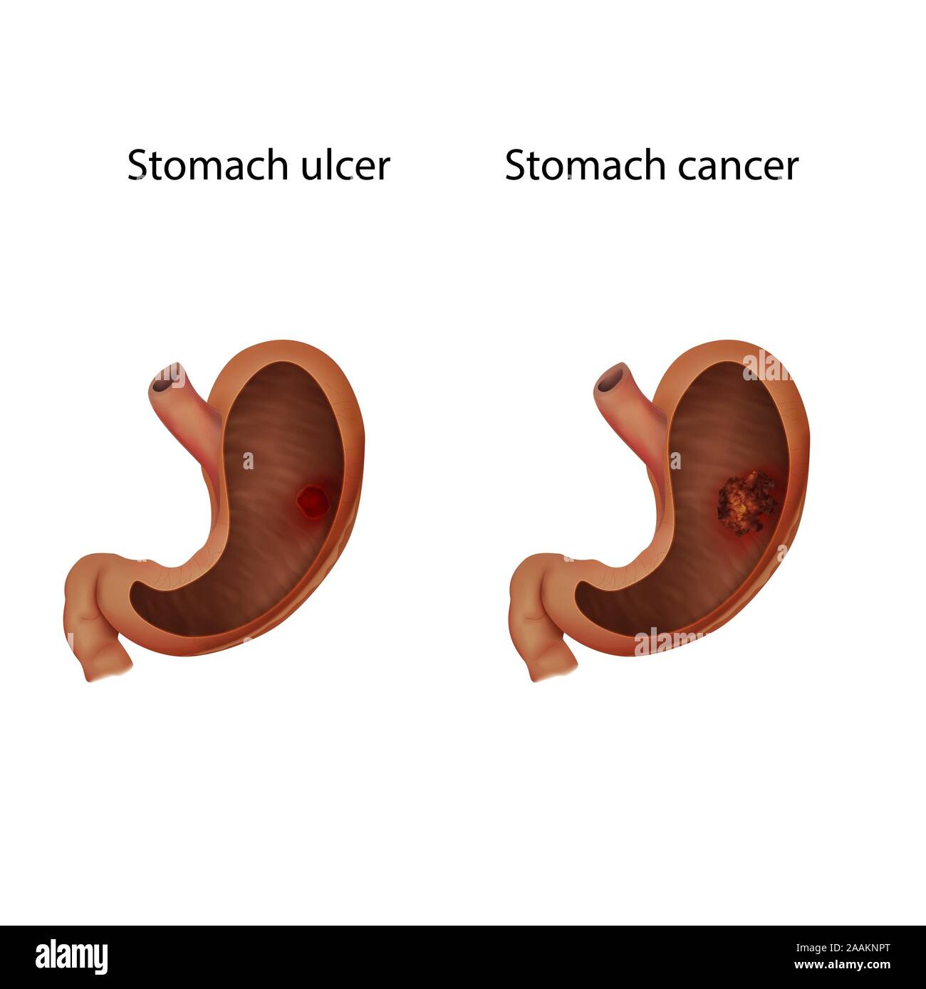Stomach ulcer and stomach cancer, illustration. Stock Photo