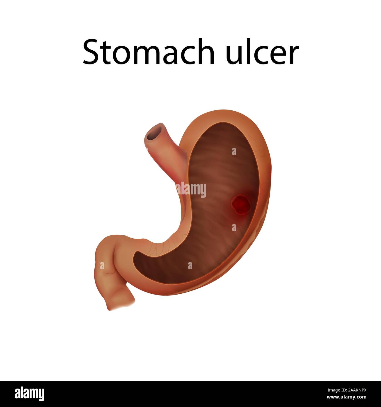 Stomach ulcer, illustration. Stock Photo