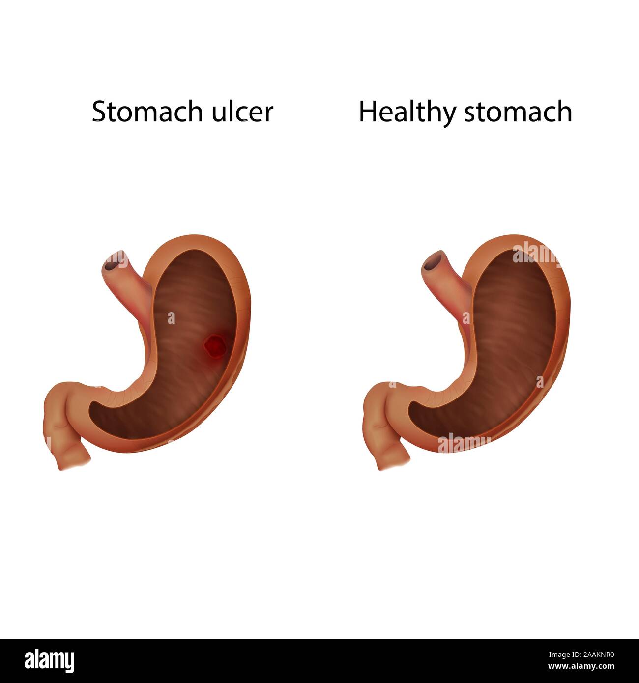 Stomach ulcer and healthy stomach, illustration. Stock Photo