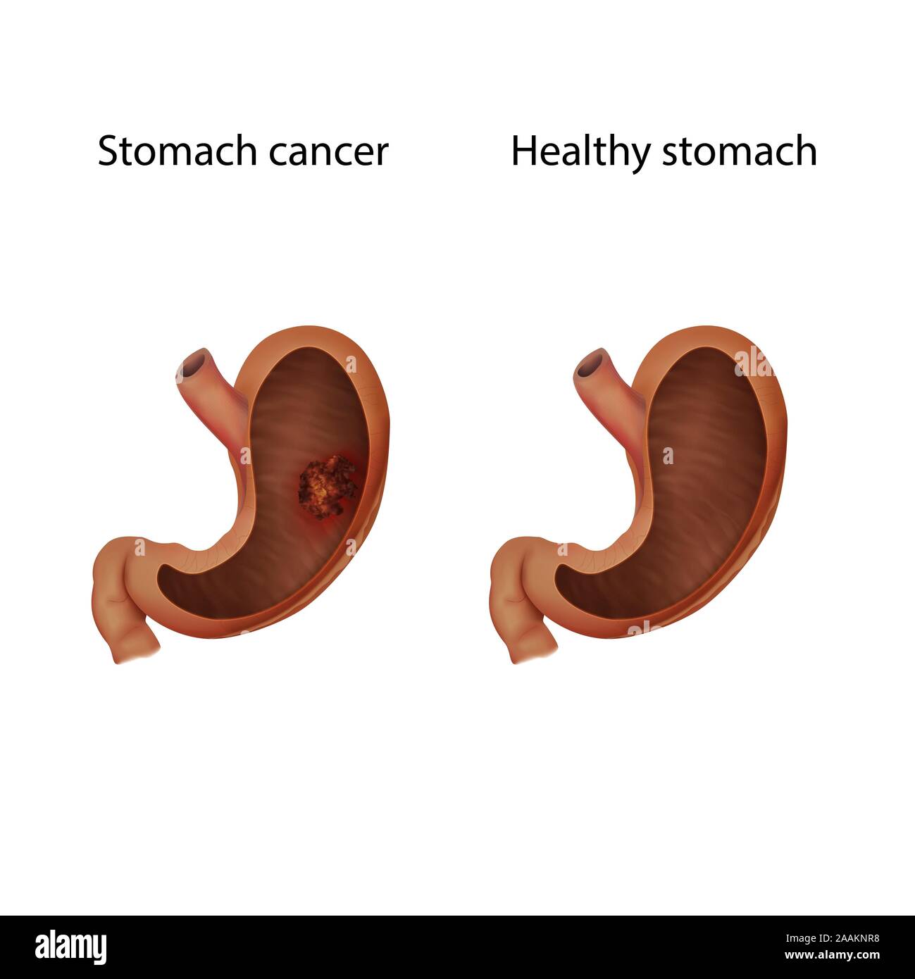 Stomach cancer and healthy stomach, illustration Stock Photo Alamy