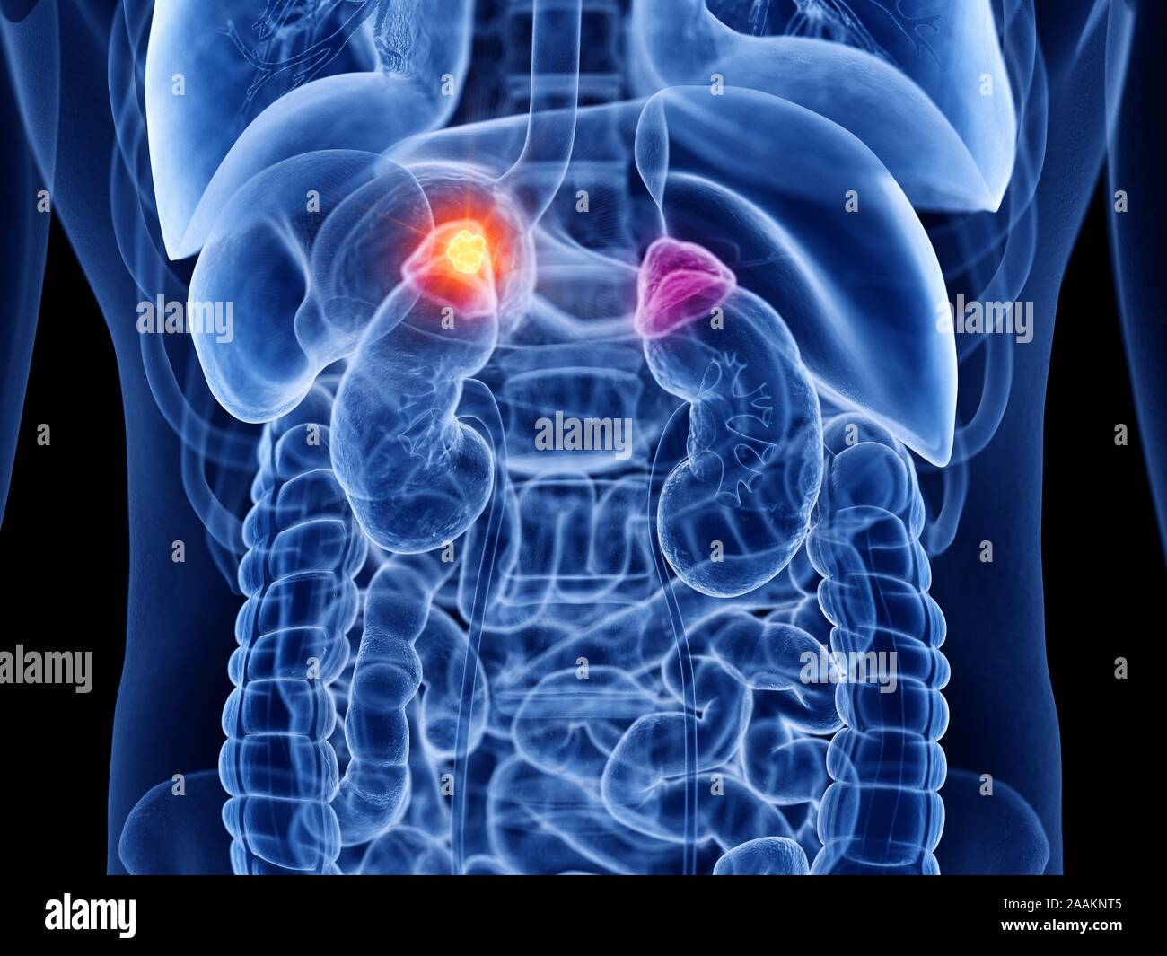 Adrenal gland cancer, computer illustration Stock Photo - Alamy