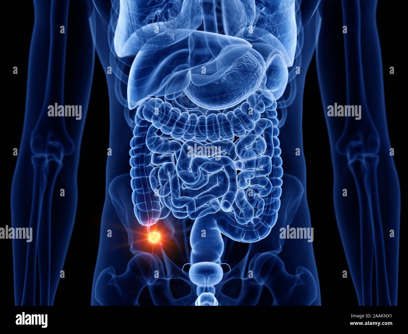 Appendix cancer, computer illustration Stock Photo - Alamy