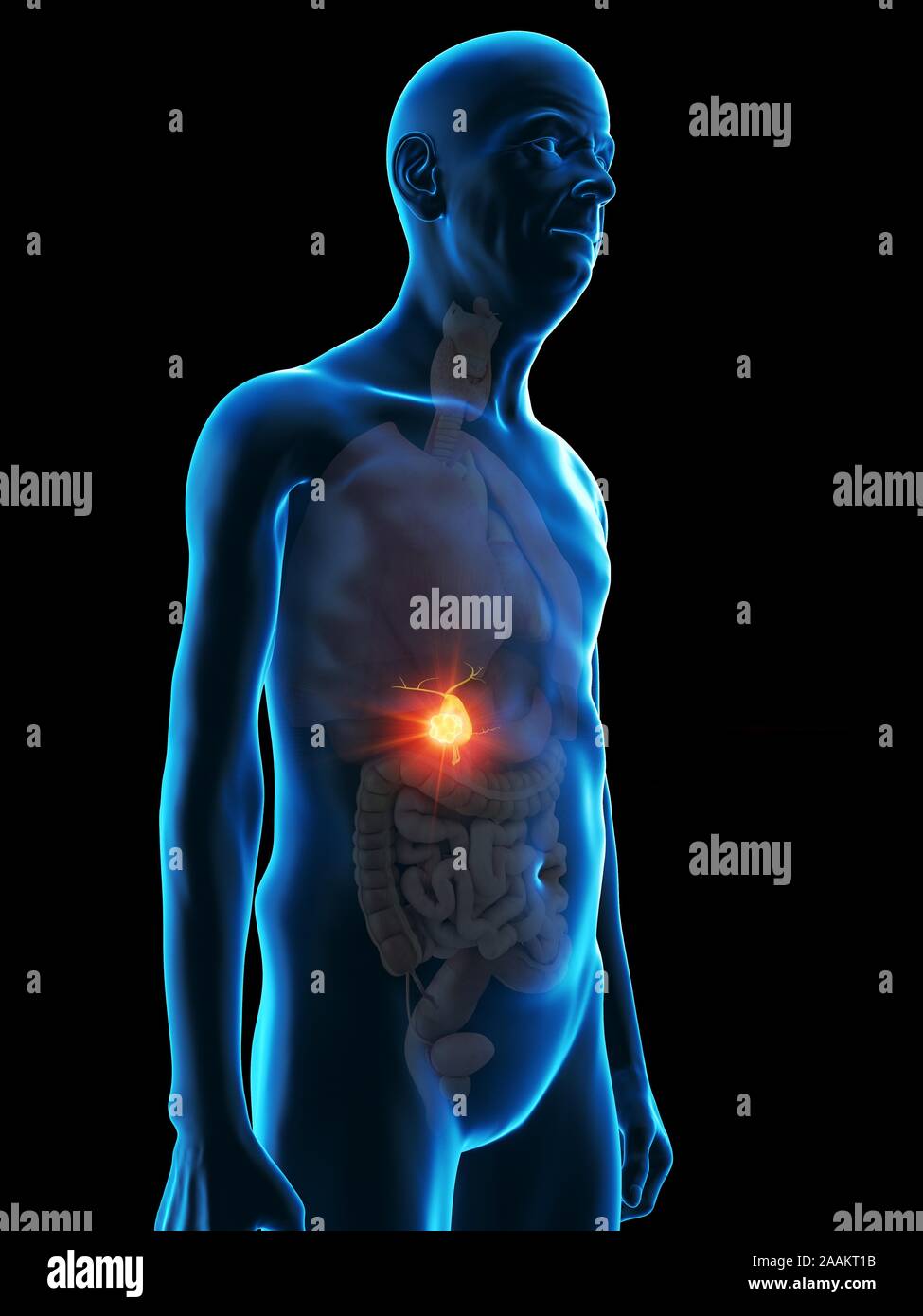 Illustration of an old man's gallbladder tumour Stock Photo - Alamy