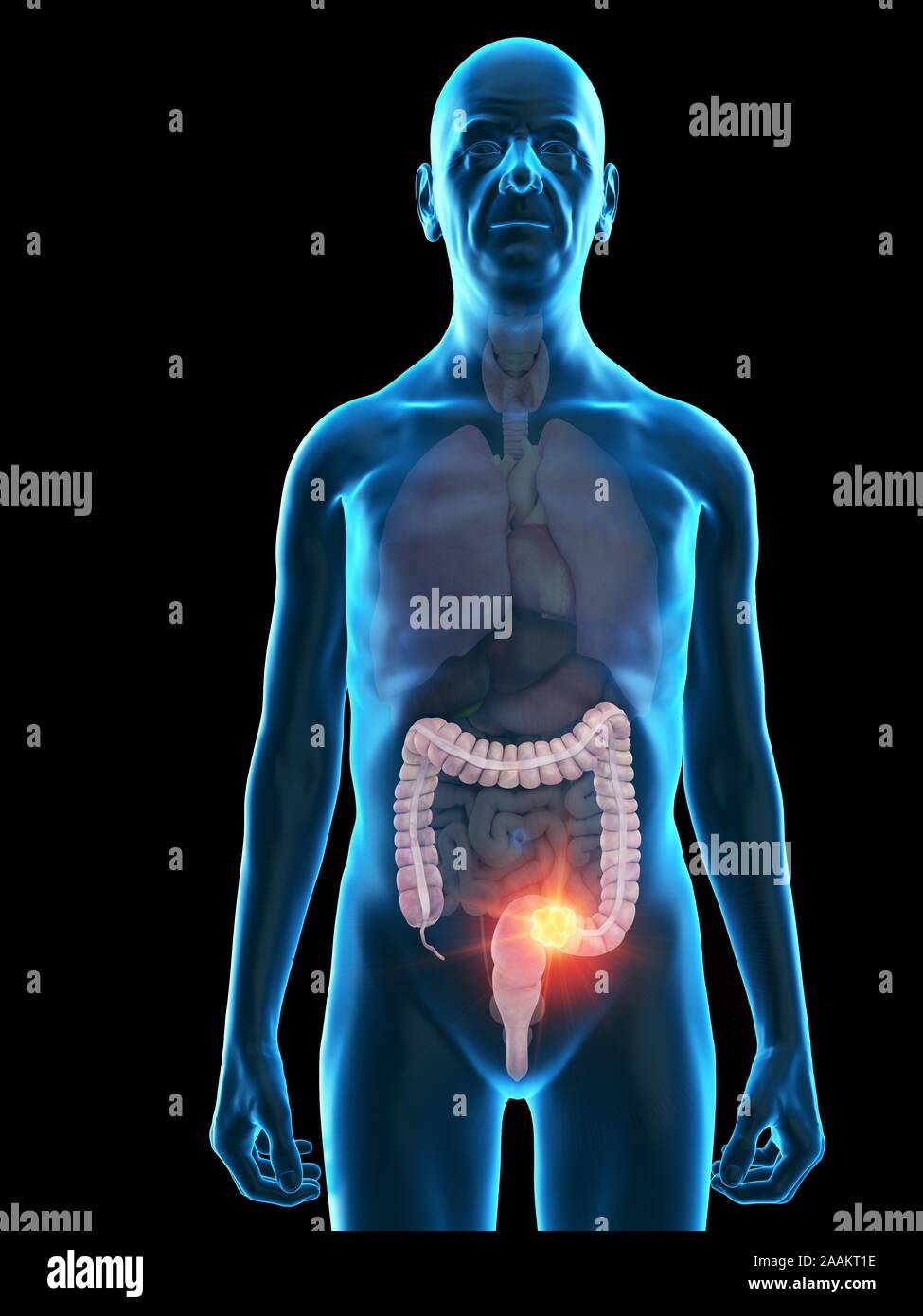 Illustration of an old man's colon tumour Stock Photo - Alamy