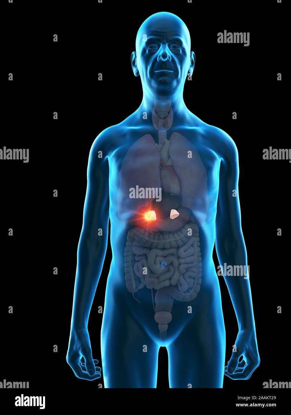 Illustration of an old man's adrenal gland tumour Stock Photo - Alamy