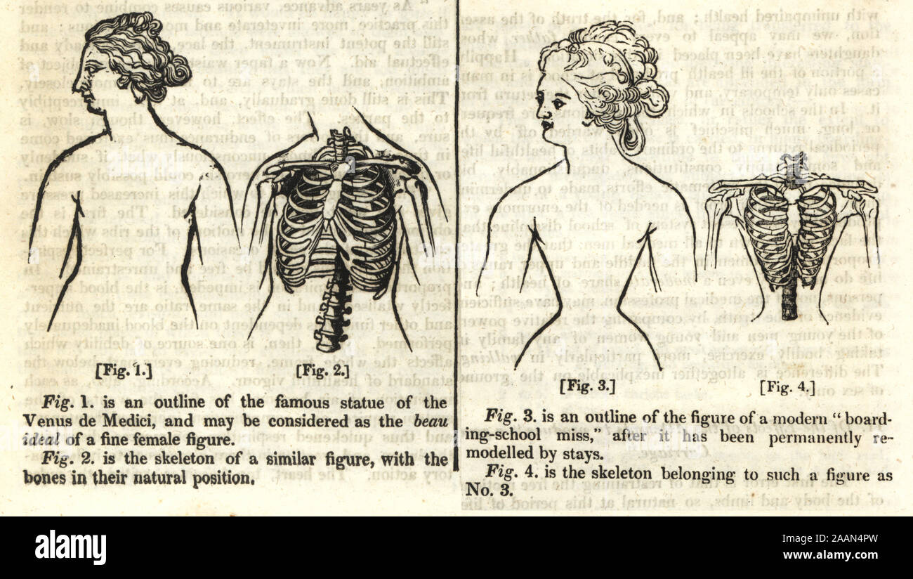 Comparison of female outline and skeleton after permanent disfigurement from whale-bone corsets from Professor Sommering's On The Effects of Stays. Woodblock engraving from The Penny Magazine, of the Society for the Diffusion of Useful Knowledge, printed by William Clowes, Lambeth, 1833. Stock Photo