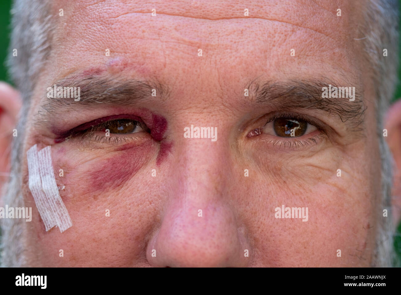 Close-up of man with black eye Stock Photo