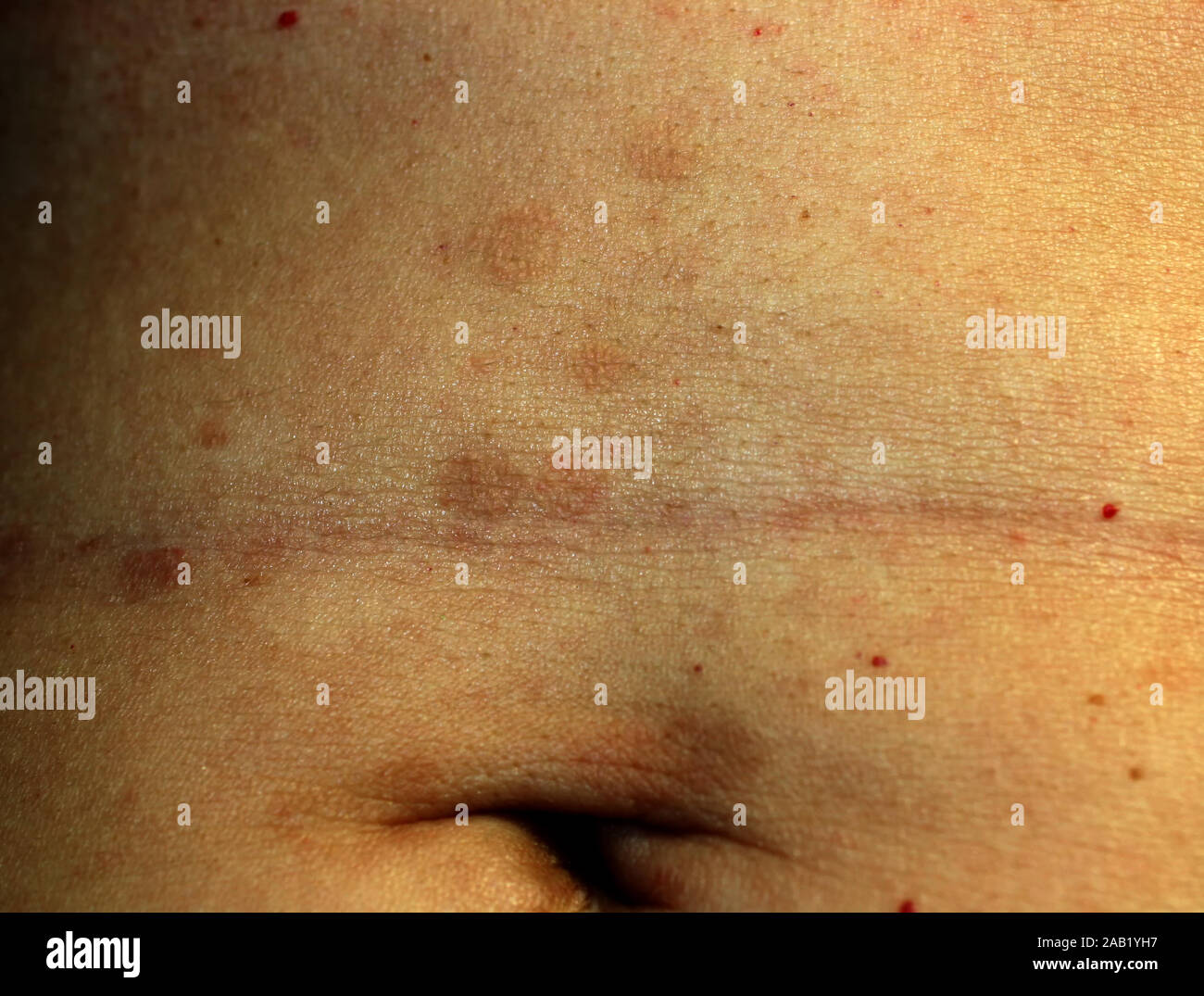 Red Flat Lichen planus. Red spots on the skin of the abdomen Stock Photo