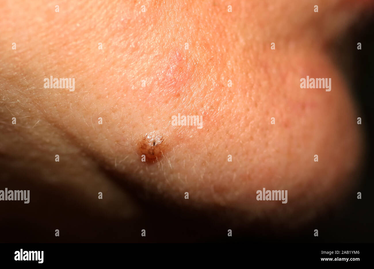 Birthmark on his chin. A mole on the skin of the face. Stock Photo