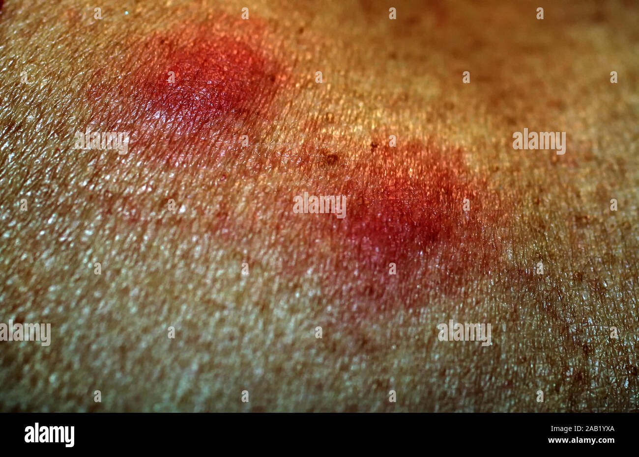 Red 2024 mosquito bite