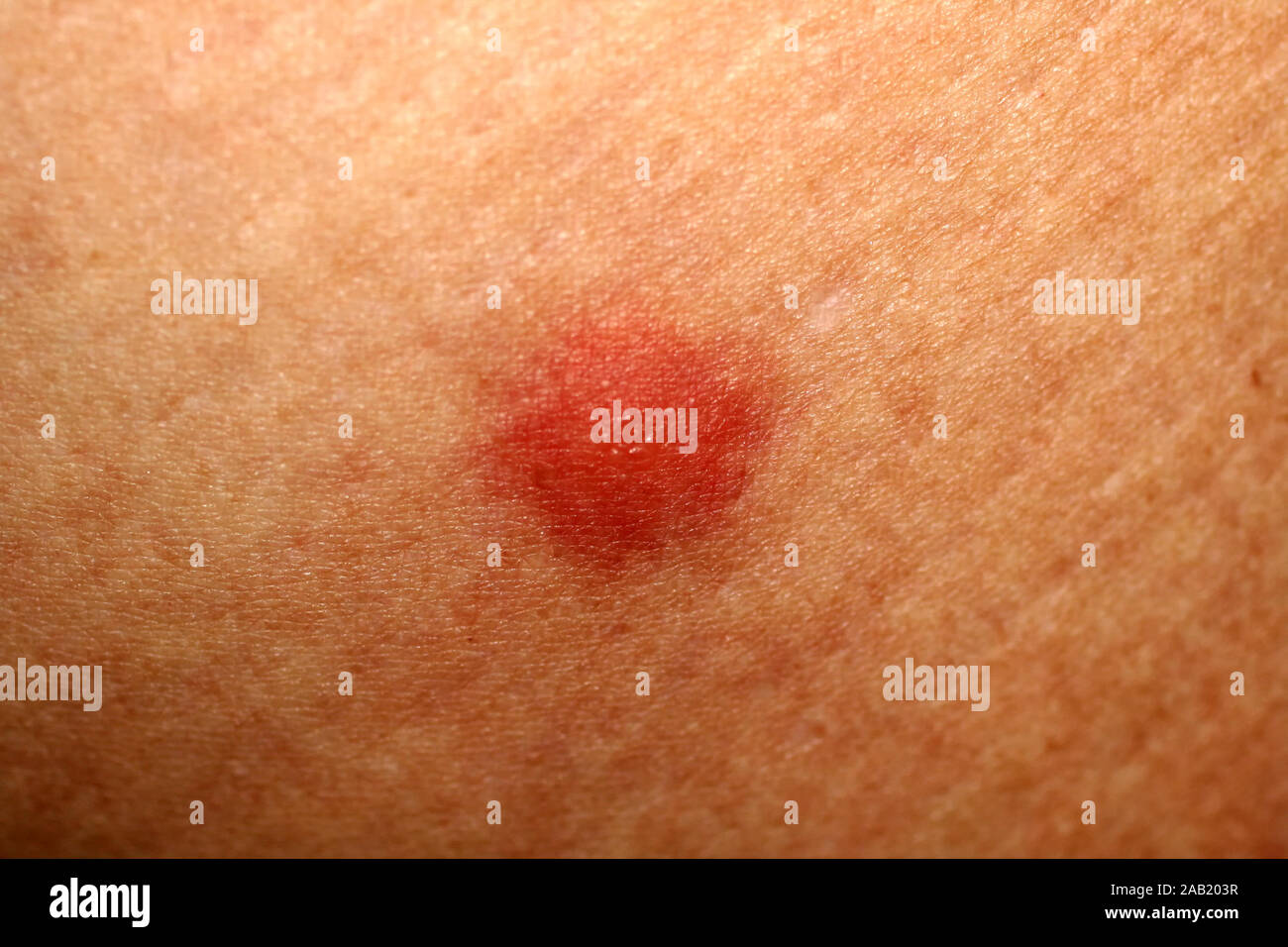 Red mosquito bites. Swelling of the skin. A bite of a wasp, a bee Stock