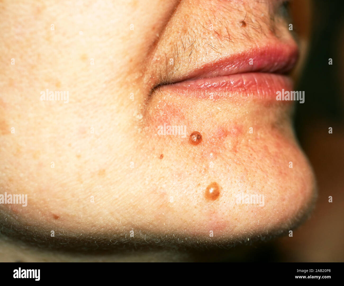 Birthmark on his chin. A mole on the skin of the face. Stock Photo