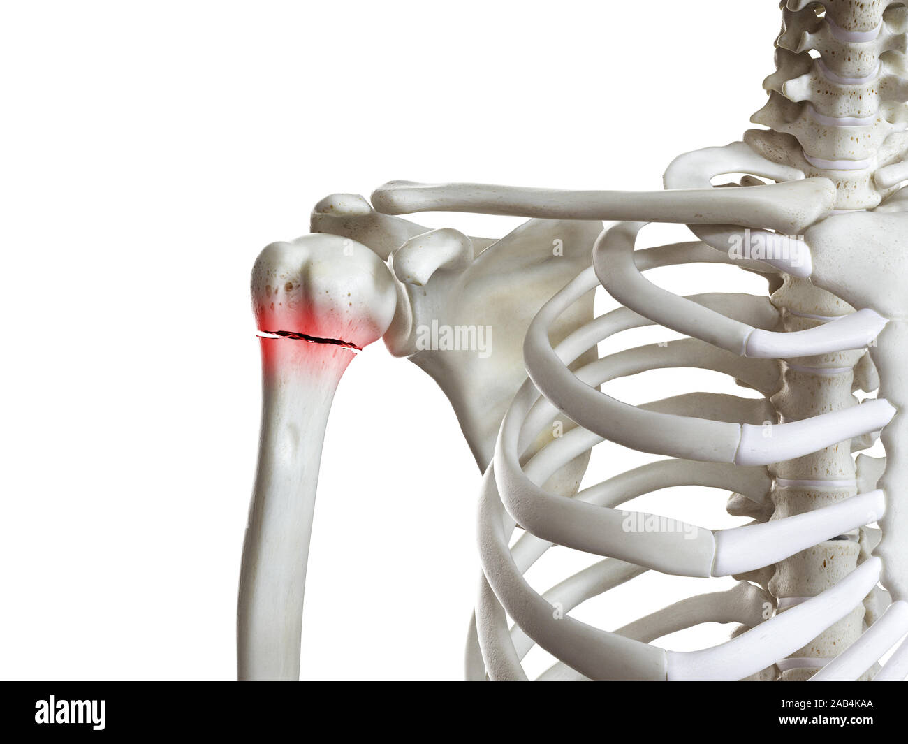 3d rendered medically accurate illustration of a broken humerus Stock