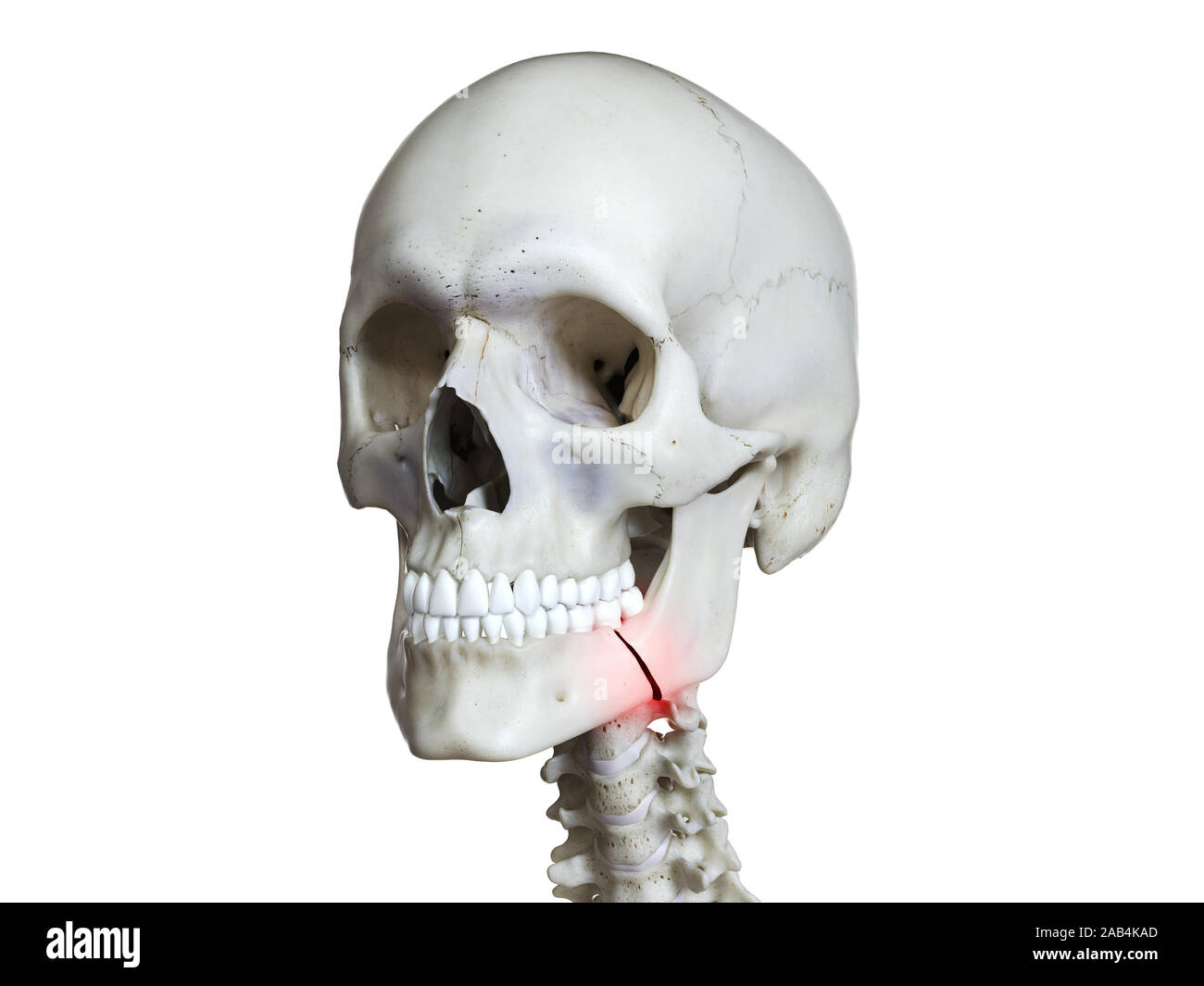 3d rendered medically accurate illustration of a broken jaw Stock Photo