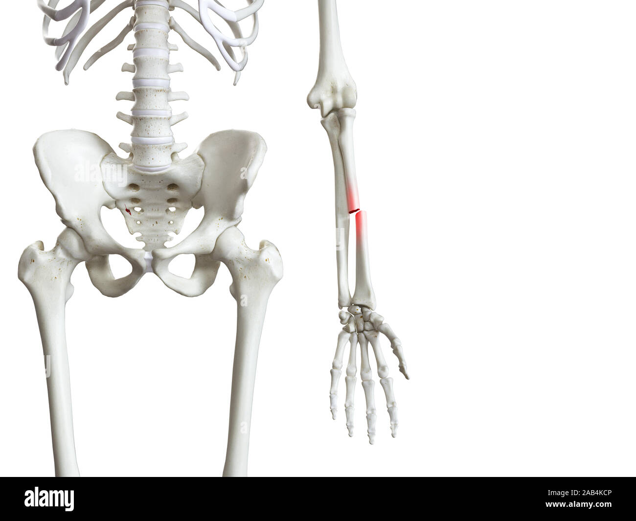 3d rendered medically accurate illustration of a broken radius Stock ...