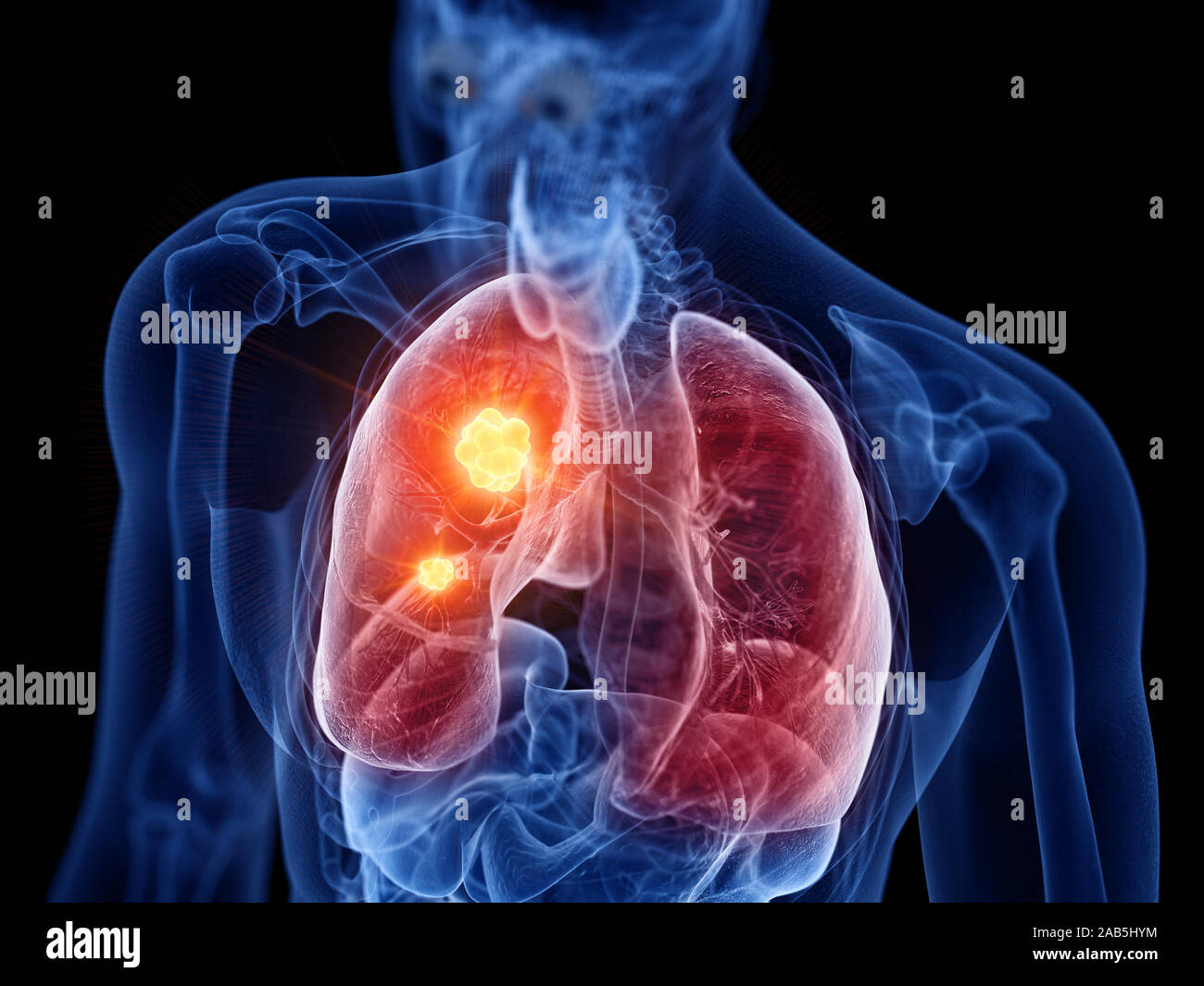 3d rendered medically accurate illustration of lung cancer Stock Photo
