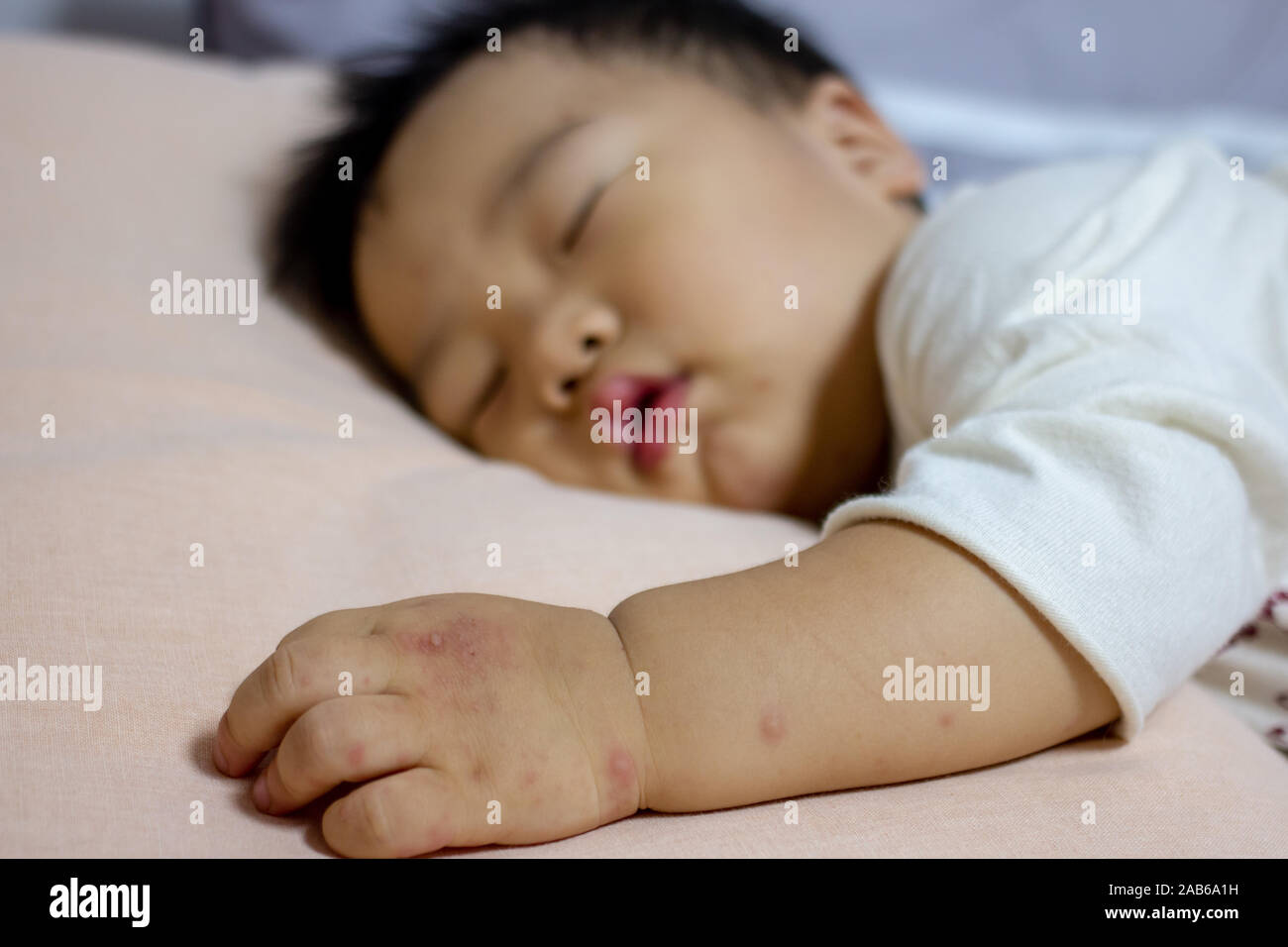 Allergic rash skin of baby's right foot. (Hand Foot and Mouth disease