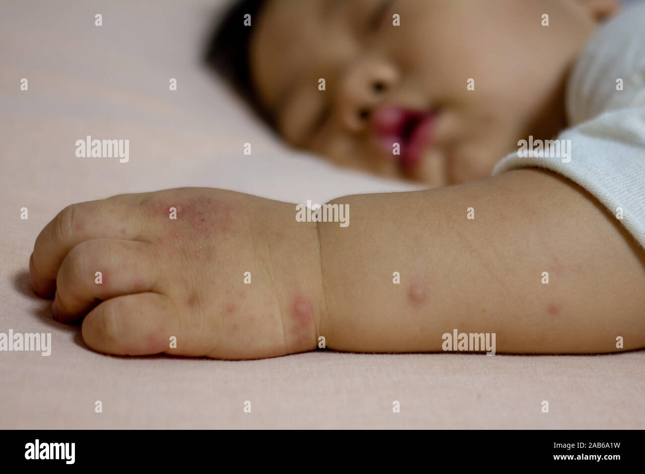 Allergic rash skin of baby's right foot. (Hand Foot and Mouth disease