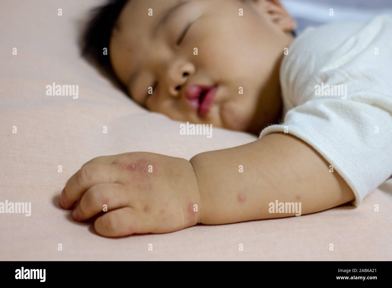 Allergic rash baby foot hires stock photography and images Alamy