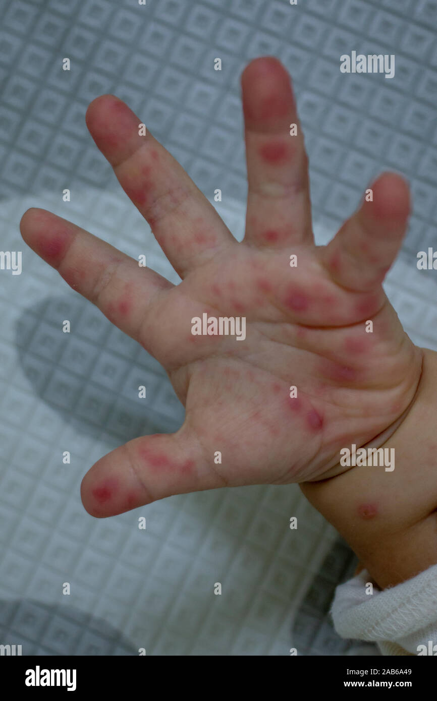 Allergic rash skin of baby's right foot. (Hand Foot and Mouth disease