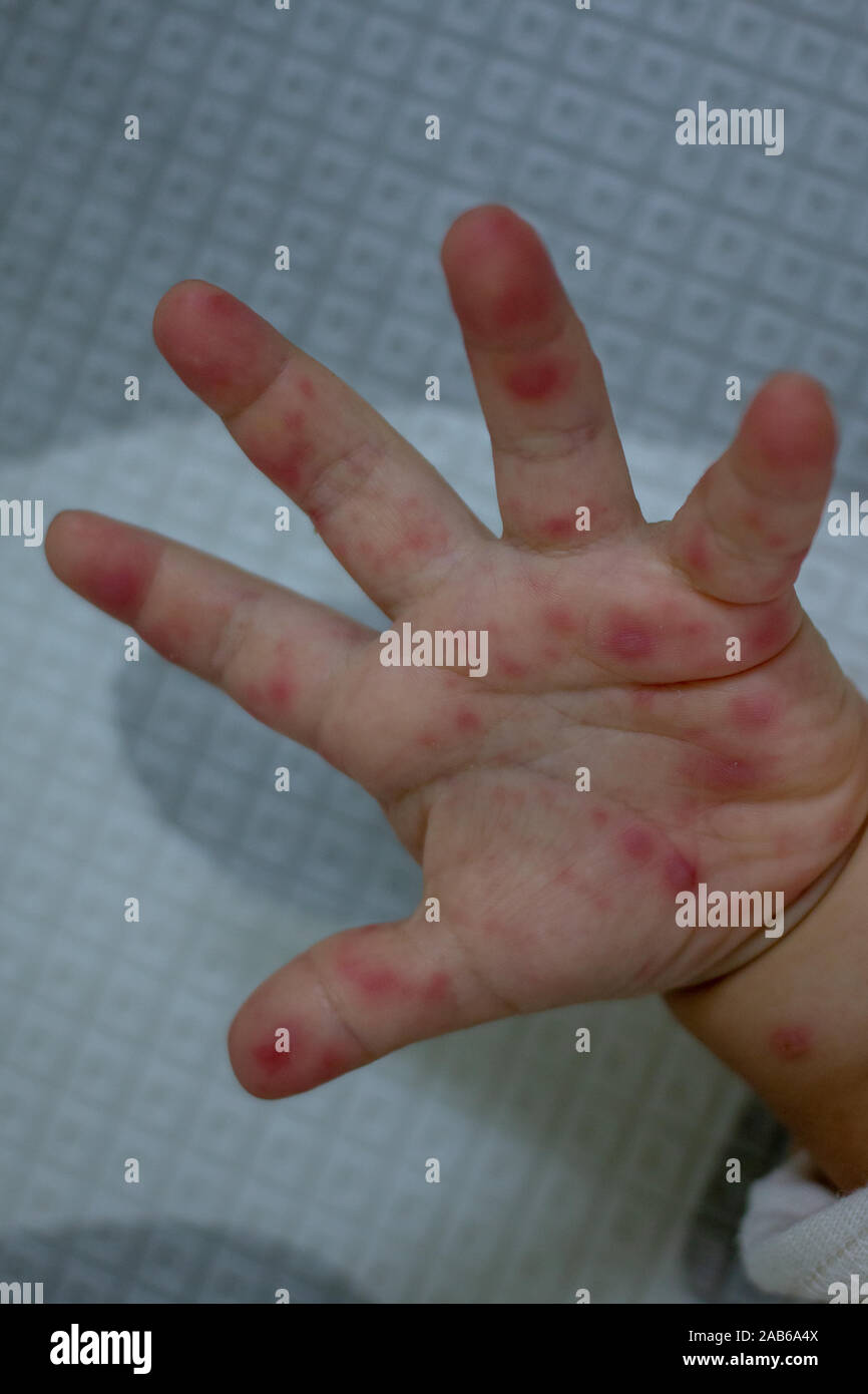 Allergic rash skin of baby's right foot. (Hand Foot and Mouth disease