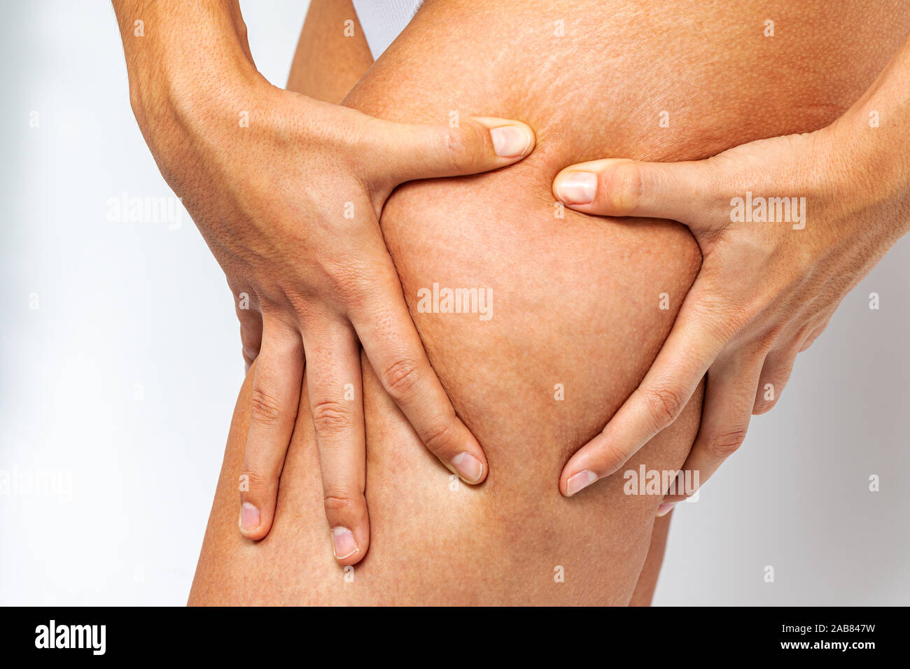 Close up of hands showing cellulite and stretch marks on female thigh. Stock Photo
