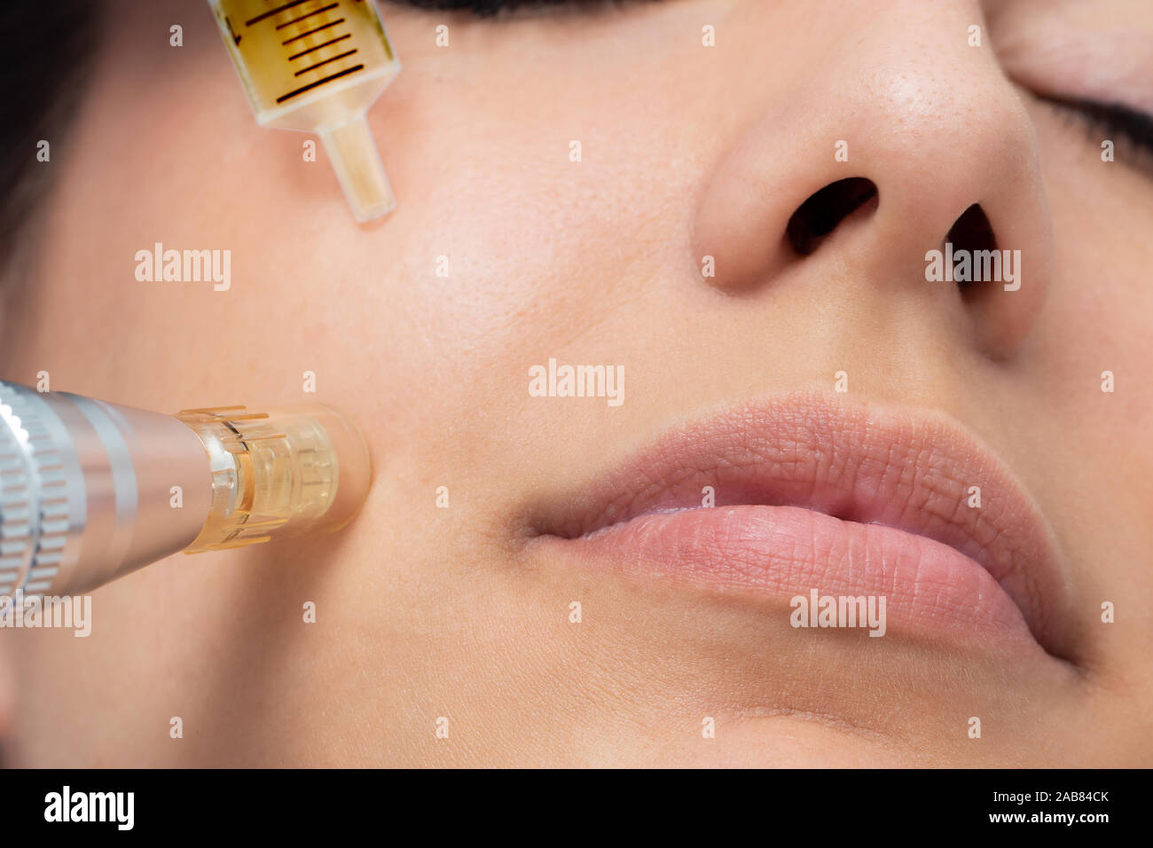 Macro detail of micro needle cosmetic treatment on female cheek. Derma pen and syringe with plant extracts next to face. Stock Photo