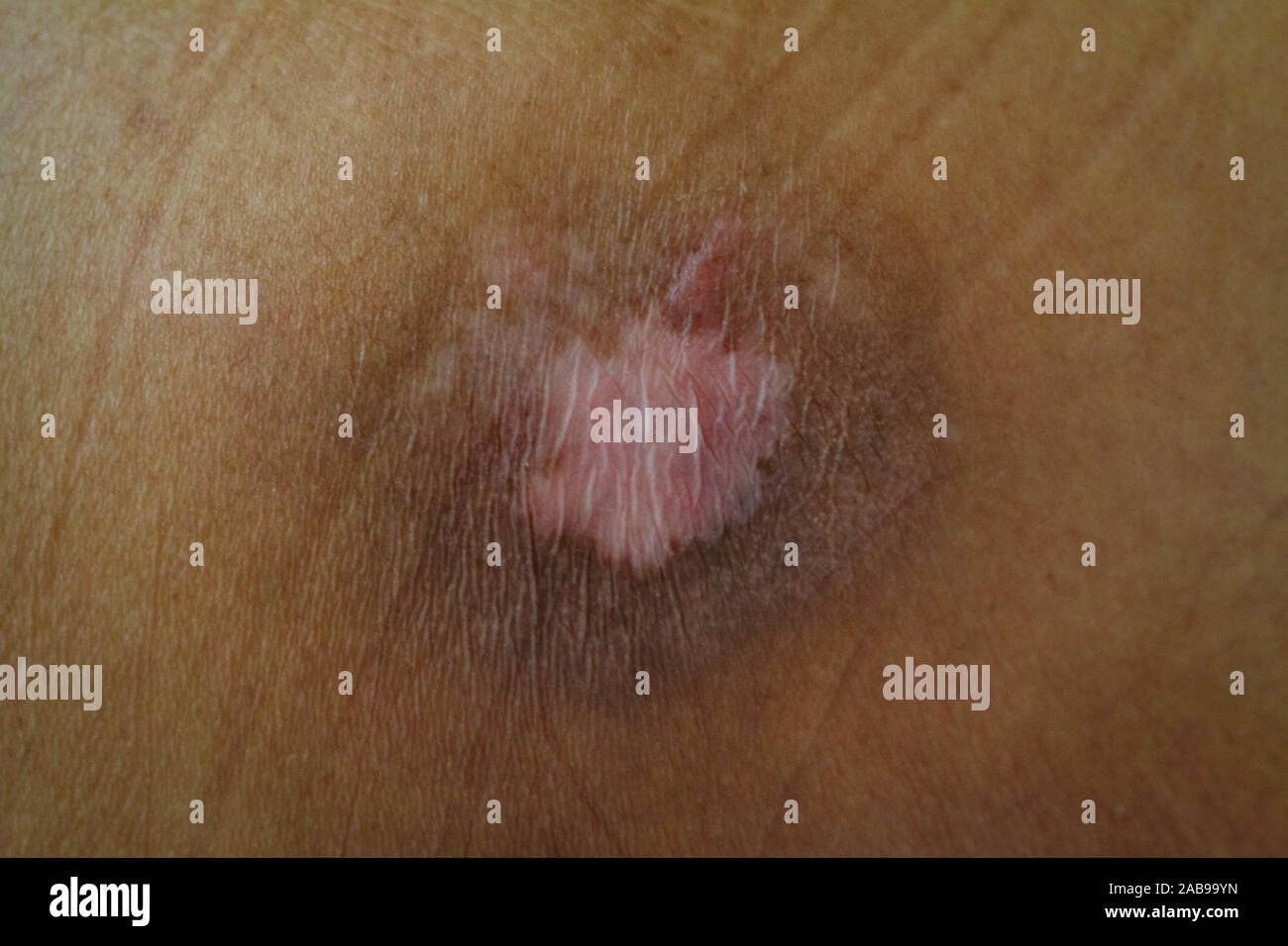 terrible bedsores with terrible wounds pressure sore on the skin of a sick lying man without the movement of an old man Stock Photo