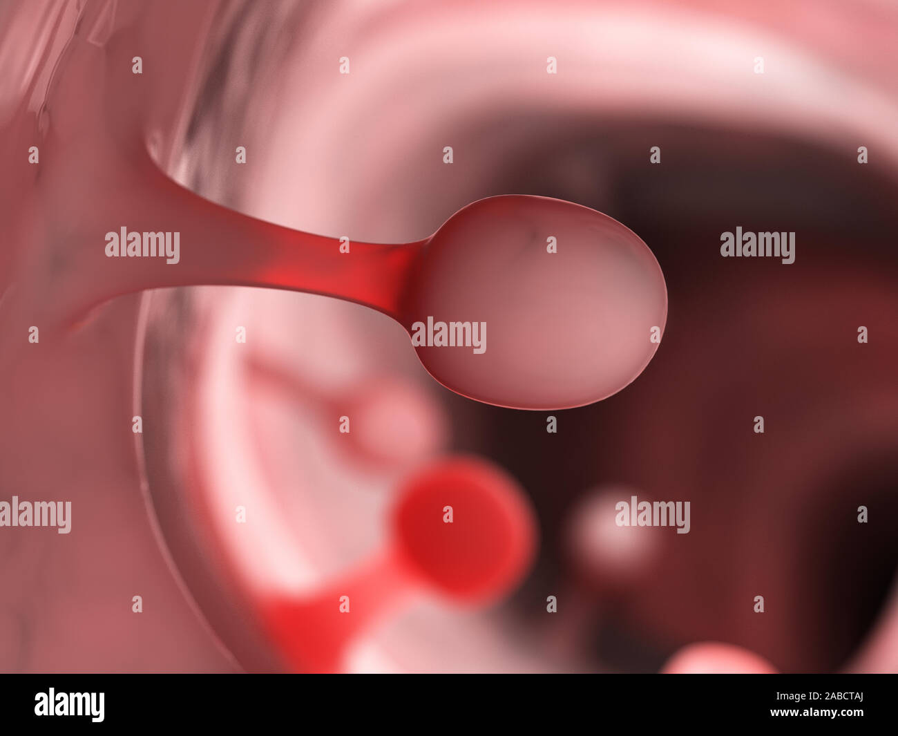 Colon Polyps Hi-res Stock Photography And Images - Alamy