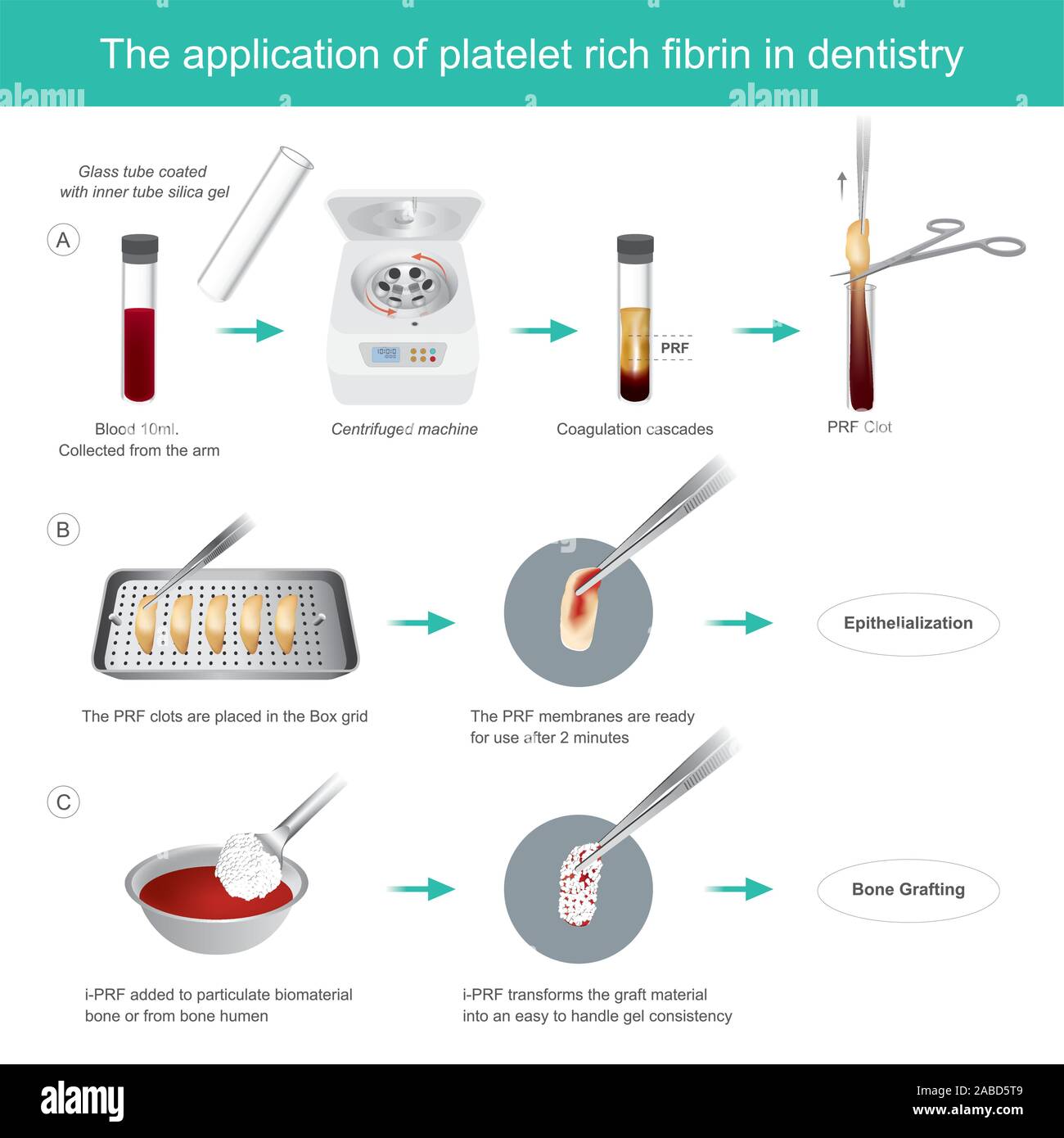 Fibrin-rich platelets (PRF) in dentistry. Development of biologically active surgical additives to control inflammation and speed up the healing proce Stock Vector